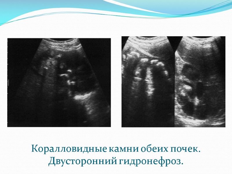 Коралловидные камни обеих почек. Двусторонний гидронефроз.